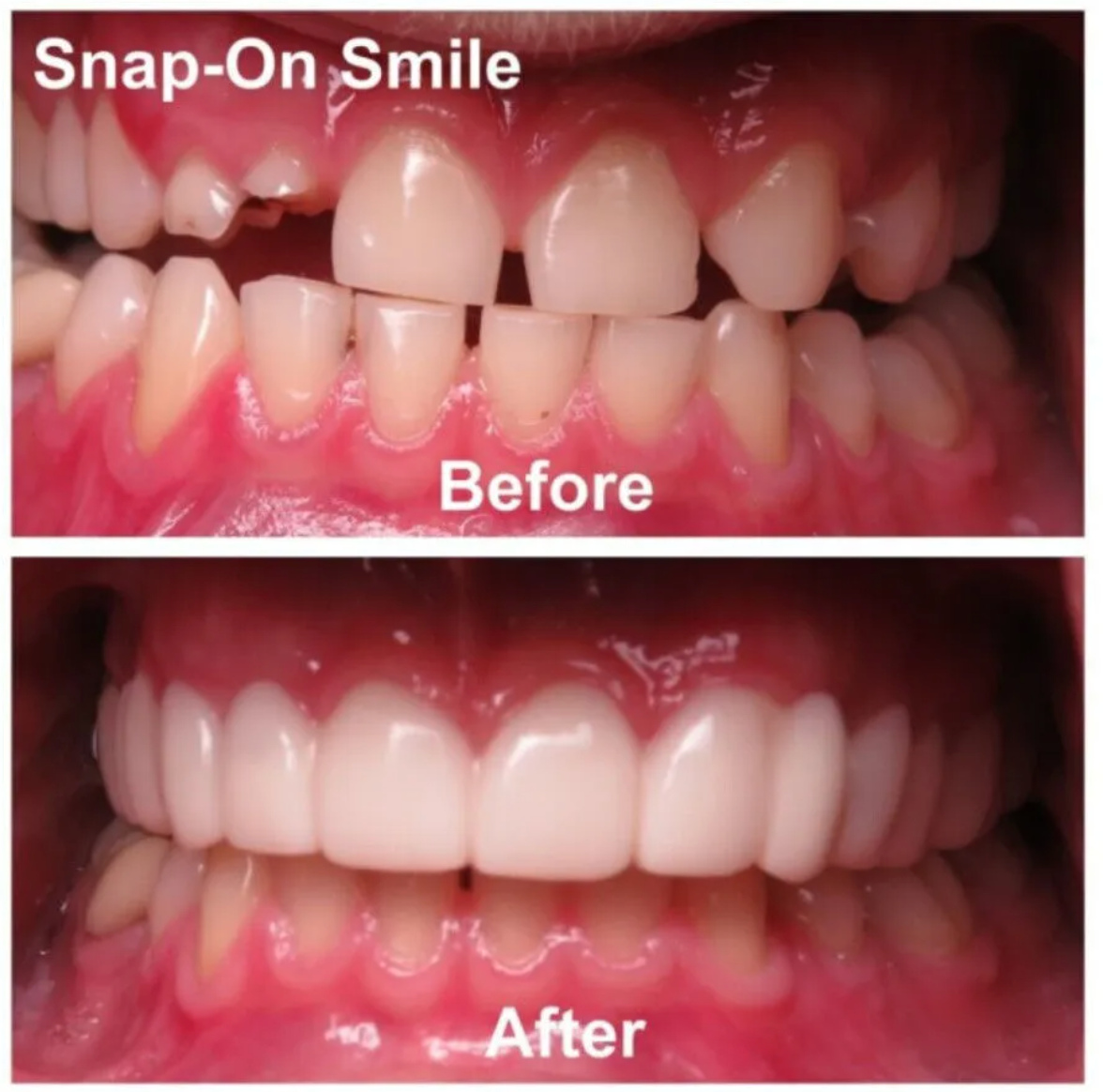 SecureSmile™ Reliner Kit