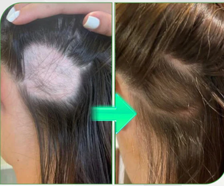 HairForce™ | Gå ut med selvtillit, få håret til å vokse effektivt på 7 dager!