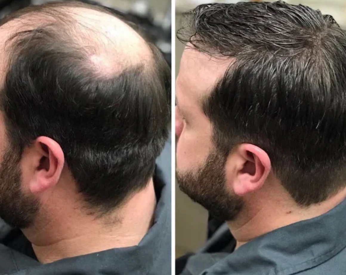 Få tilbake fyldigere, sterkere hår – naturlig og effektivt!