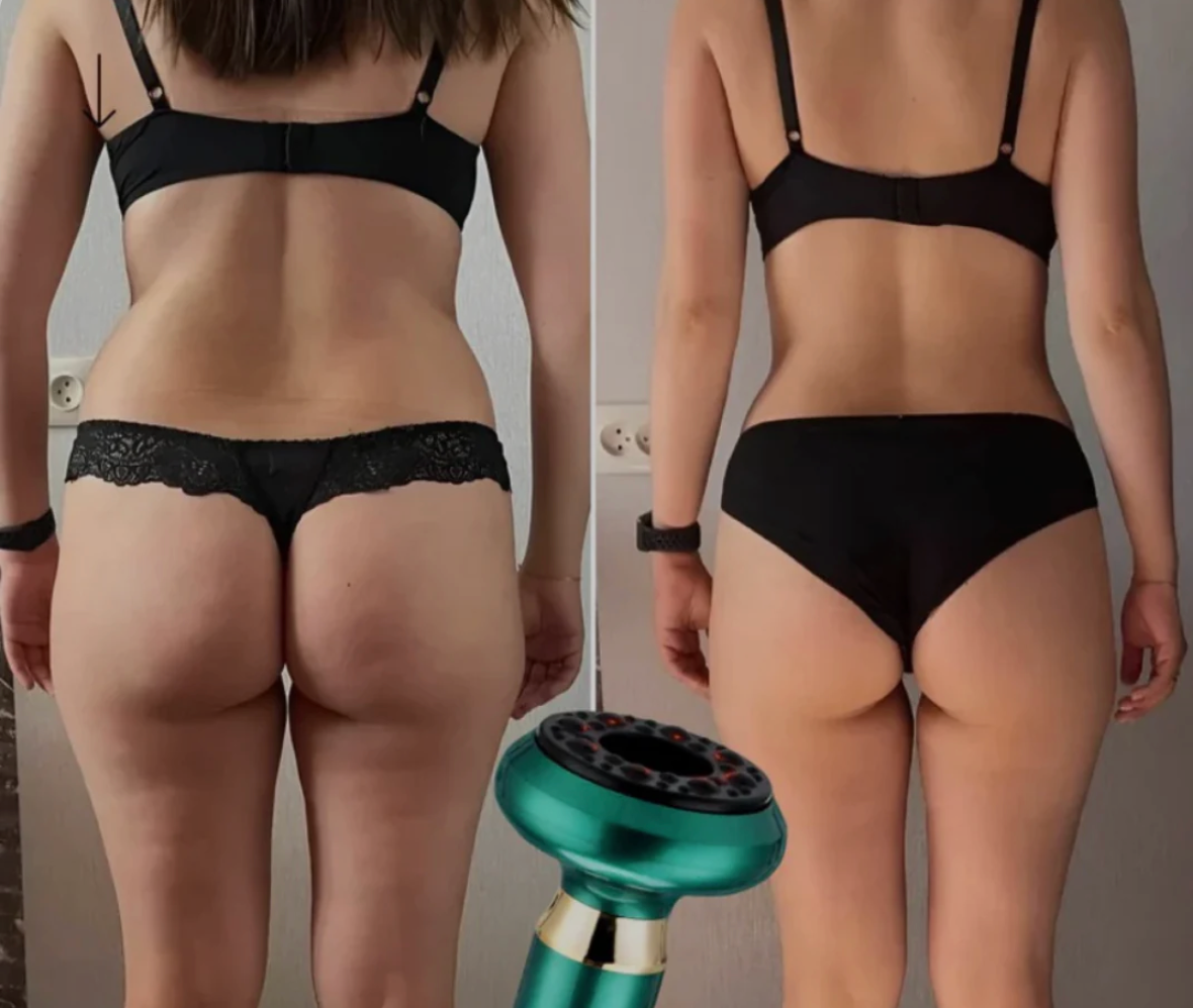 SilvaSculpt™ | Si farvel til cellulitter og hei til din beste hud noensinne