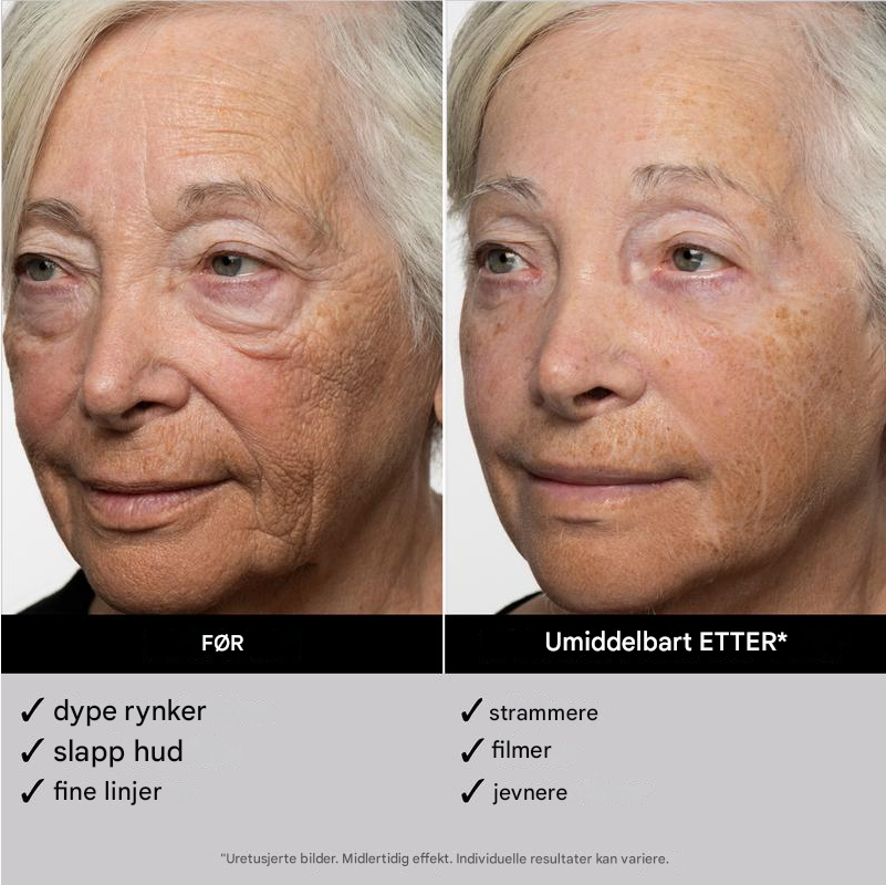 Face Tightener - Umiddelbar oppstramming og et ungdommelig utseende