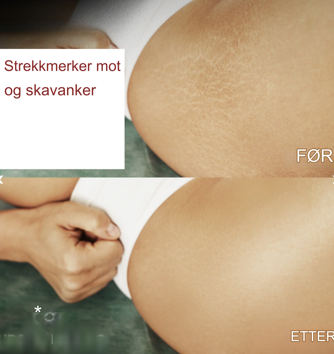 Firming™ | Fast og oppstrammet hud med 99 % etter 1 uke