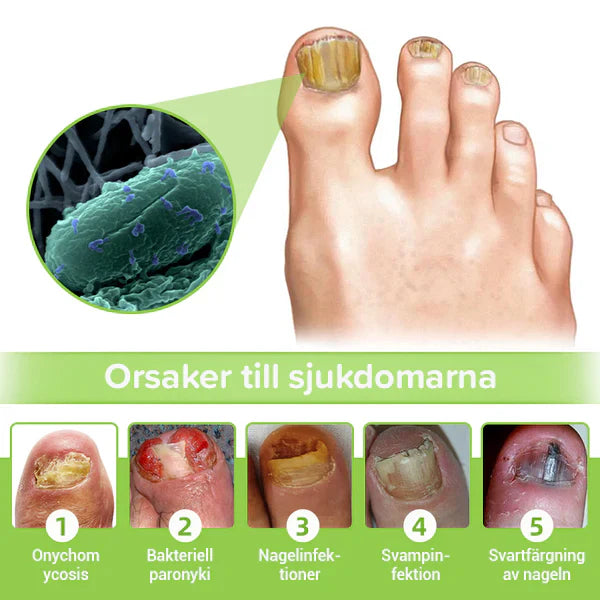 NailBeam™️ | Fjern neglesopp innen 7 dager!