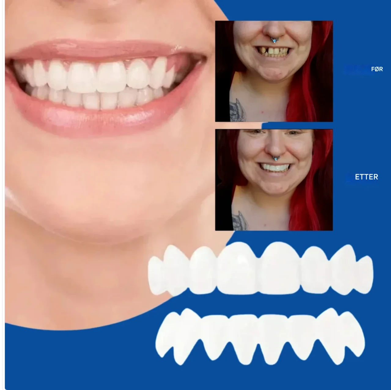 Selvsikkert smil på få minutter - uten tannlegebesøk, uten smerte uten høye kostnader